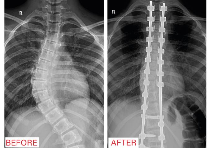 Rescuing a girl who was suffering from scoliosis in Al-Mouwasat Hospital in Riyadh